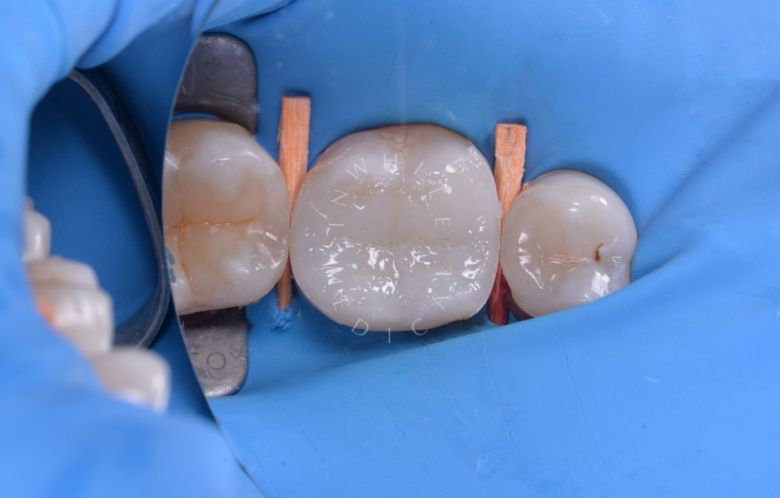 Элитная стоматология. Одиночный кариес жевательного зуба – результат художественной реставрации - фото после процедуры