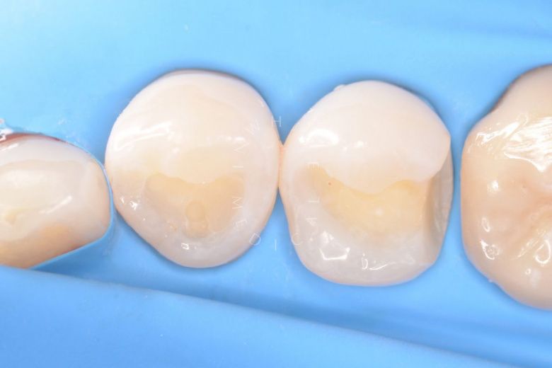 Лучшие стоматологические клиники Москвы. Лечение контактного кариеса - фото до процедуры