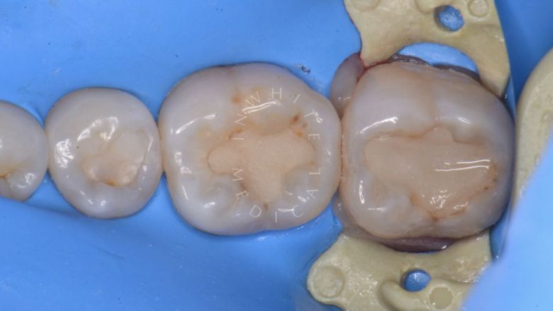 Где лучшая стоматология? Замена старых пломб с лечением кариеса. Восстановление зубов с восстановлением анатомических ориентиров - фото до процедуры