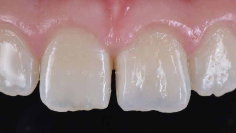Где лучшая стоматология? Замена старой пломбы. Художественная реставрация зуба с восстановлением оптических характеристик - фото после процедуры