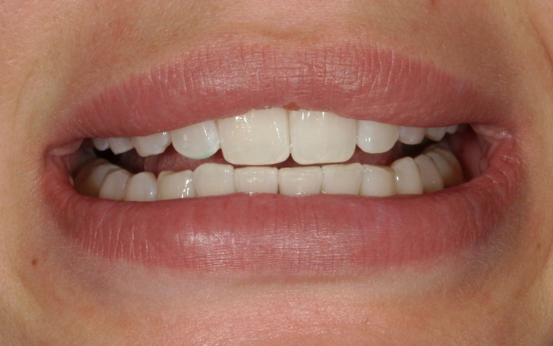 Элитная стоматология. Отбеливание зубов - photo after the procedure