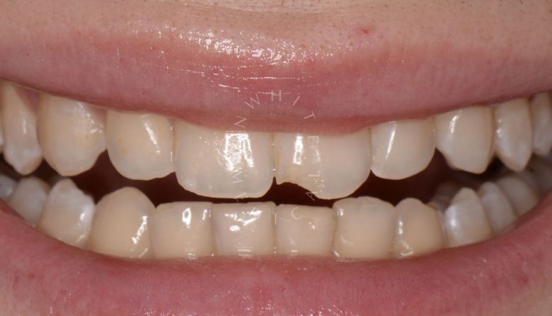 Где лучшая стоматология? Художественная реставрация с использованием композитного материала за один визит - фото до процедуры