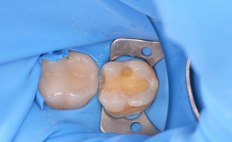 Элитная стоматология. Лечение кариеса жевательного зуба - фото до процедуры