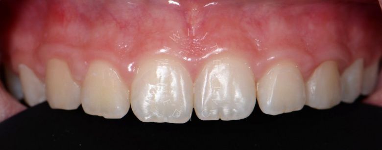 Лучшие стоматологические клиники Москвы.  Композитные виниры в зоне улыбки - фото до процедуры