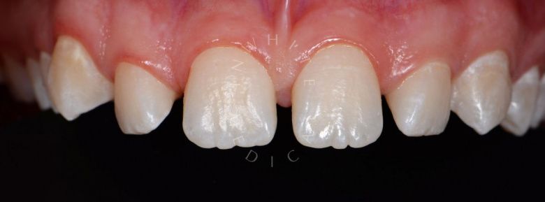 Лучшие стоматологические клиники Москвы.  Эстетические реставрации в зоне улыбки - фото до процедуры