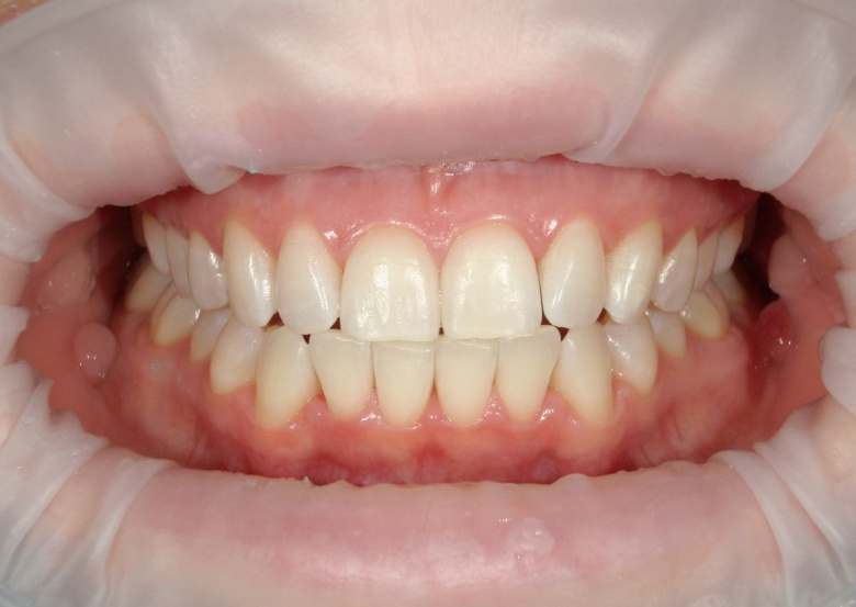 Элитная стоматология. Отбеливание - photo after the procedure