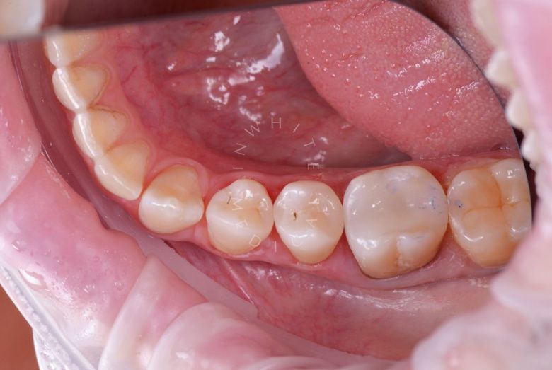 Элитная стоматология. Восстановление зуба после скола – эстетическая реставрация - фото после процедуры