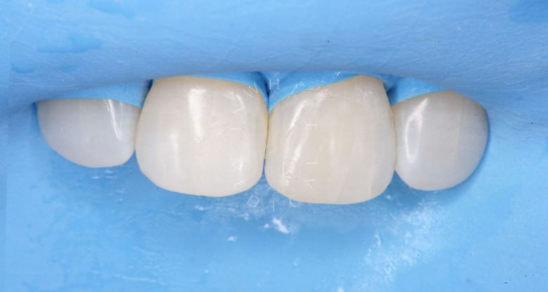 Где лучшая стоматология? Лечение межзубного кариеса фронтальных зубов - фото после процедуры