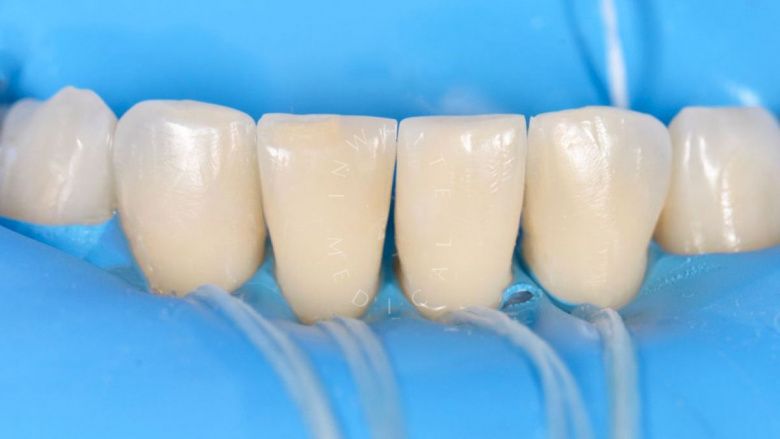 Где лучшая стоматология? Эстетическая реставрация фронтальных зубов после лечения кариеса - фото после процедуры