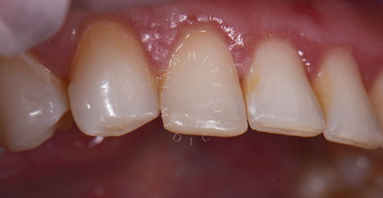 Лучшие зубные клиники Москвы. Реставрация сколов зуба - photo after the procedure