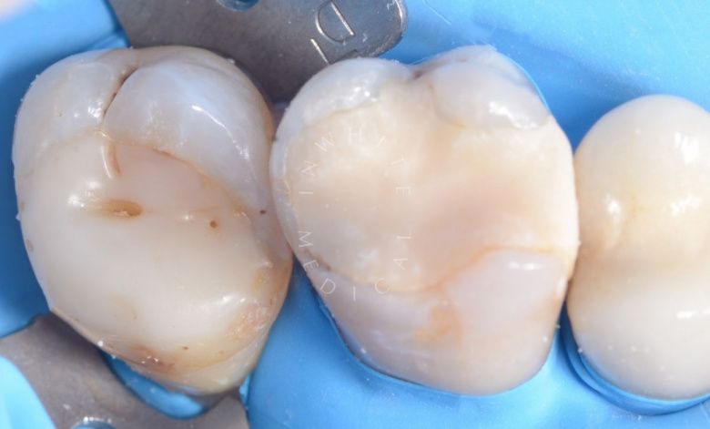 Лучшие стоматологические клиники Москвы. Глубокий кариес жевательного зуба – сохранение зуба - фото до процедуры