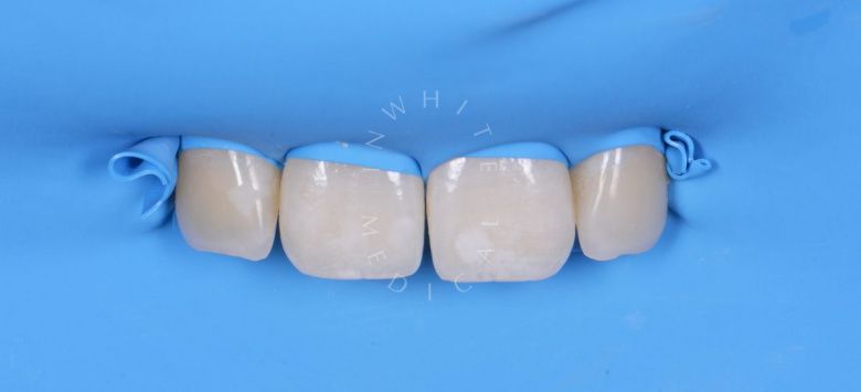 Элитная стоматология. Лечение скрытого межзубного кариеса - фото до процедуры