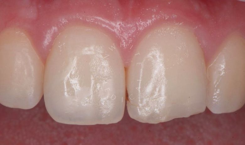 Где лучшая стоматология? Реставрация зуба с восстановлением естественной формы - фото до процедуры