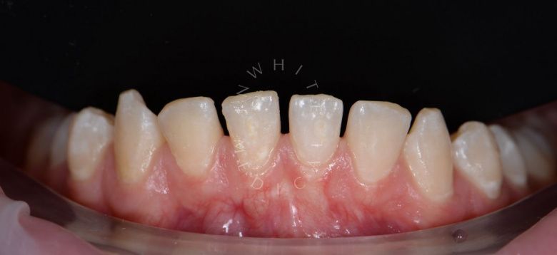 Лучшие стоматологические клиники Москвы.  Восстановление эстетики нижних фронтальных зубов композитными винирами - фото до процедуры