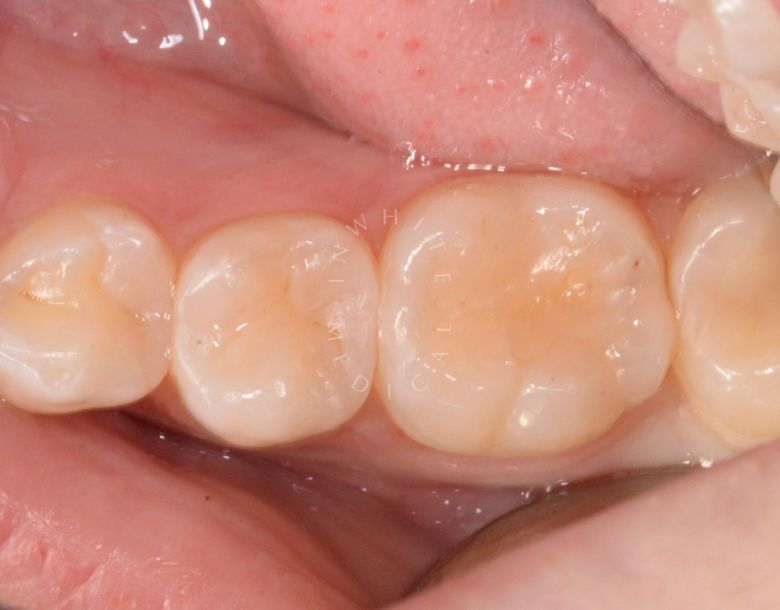 Лучшие зубные клиники Москвы. Поверхностный кариес фиссур – терапия без осложнений - фото до процедуры