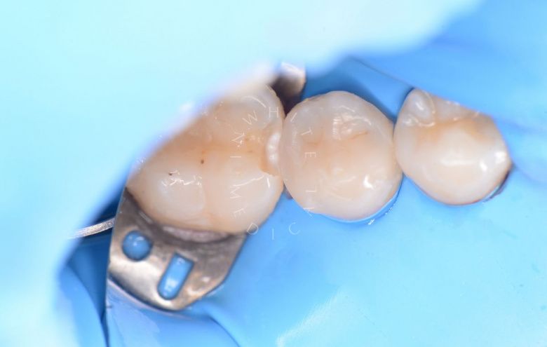 Где лучшая стоматология? Скрытый межзубный кариес – диагностика и лечение - фото до процедуры