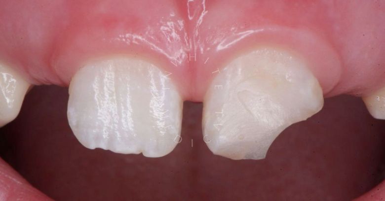 Где лучшая стоматология? Восстановление эстетики фронтального зубы - фото до процедуры