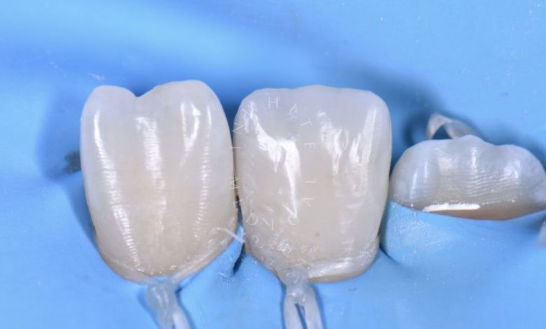 Где лучшая стоматология? Прямая реставрация центрального резца нижней челюсти - фото после процедуры