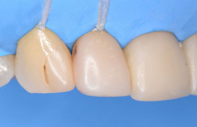 Лечение кариеса с эстетической реставрацией в Москве - фото до процедуры