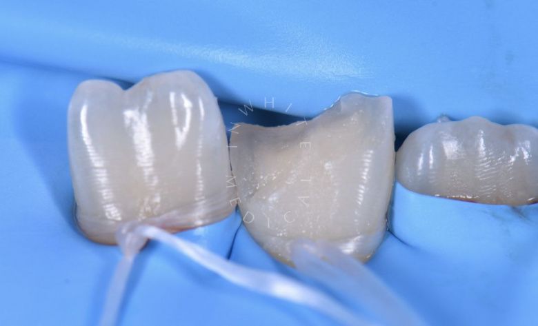 Где лучшая стоматология? Прямая реставрация центрального резца нижней челюсти - фото до процедуры