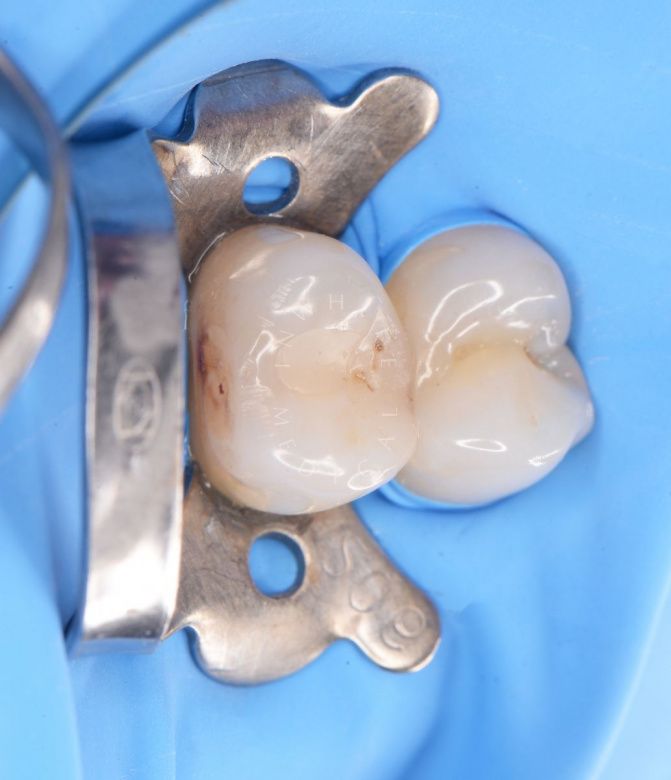 Где лучшая стоматология? Контактный кариес: лечение межзубного поражения - фото до процедуры