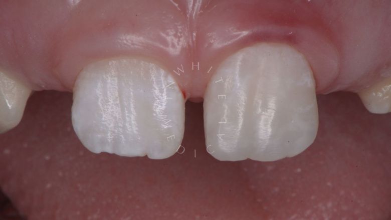 Где лучшая стоматология? Прямая реставрация с использованием композитного материала в одно посещение - фото после процедуры