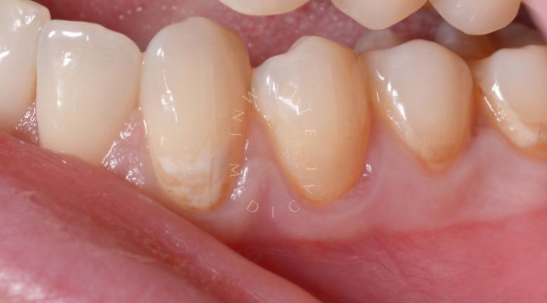 Лучшие зубные клиники Москвы. Пришеечный кариес переднего зуба – художественная реставрация - фото до процедуры