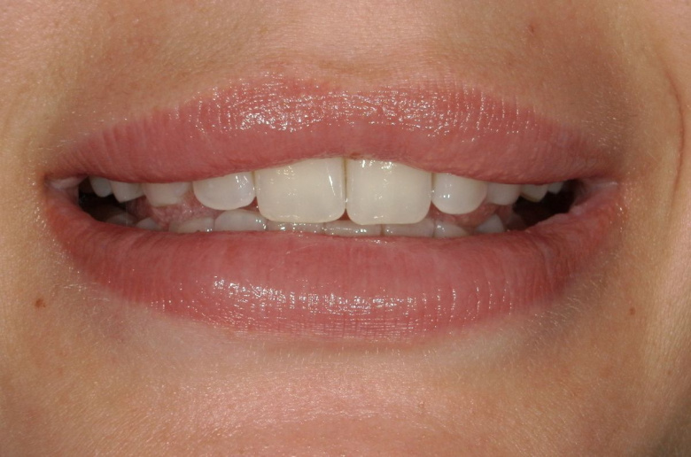 Элитная стоматология. Отбеливание зубов - photo before the procedure