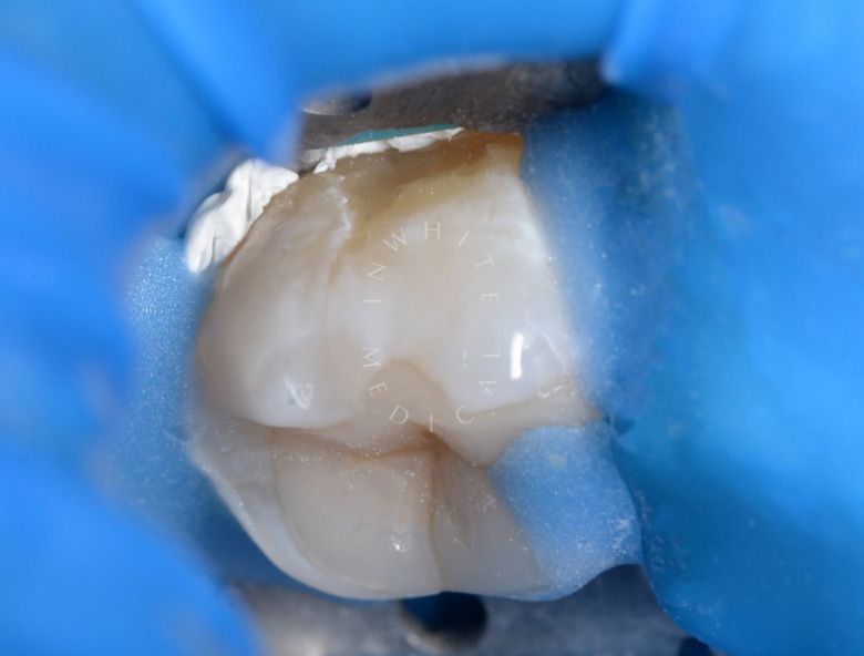 Лучшие стоматологические клиники Москвы. Пришеечный кариес с чувствительностью зуба - фото до процедуры