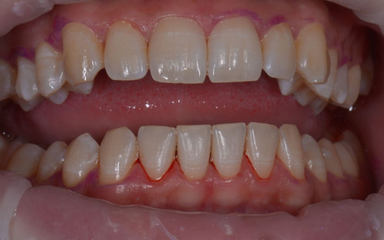 Элитная стоматология. Профессиональная гигиена - photo after the procedure