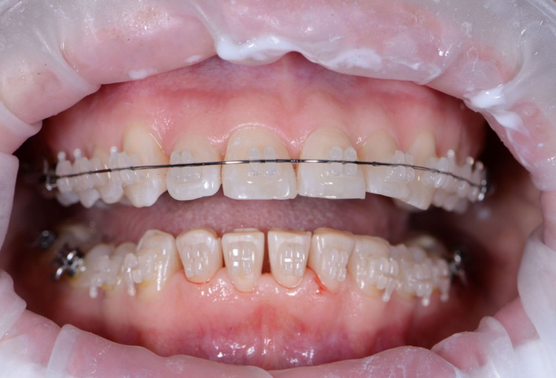 Элитная стоматология. Профессиональная гигиена - photo after the procedure