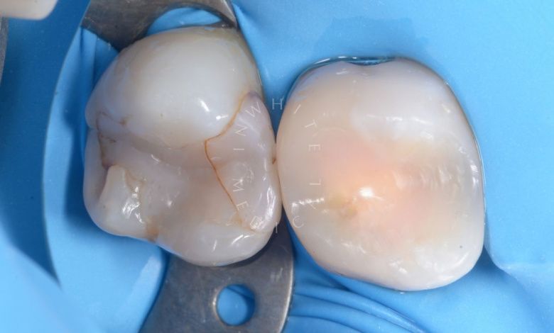 Лучшие зубные клиники Москвы. Замена старой пломбы с повторным лечением кариеса - фото до процедуры