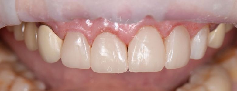 Лучшие стоматологические клиники Москвы.  Композитная реставрация 4 верхних зубов в зоне улыбки - фото после процедуры