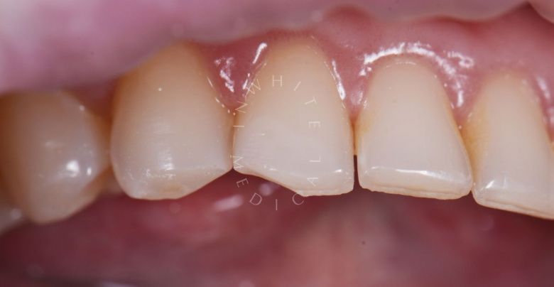 Лучшие зубные клиники Москвы. Реставрация сколов зуба - фото до процедуры