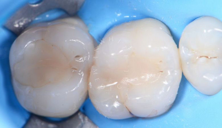 Лучшие стоматологические клиники Москвы. Лечение кариеса с восстановлением анатомии зуба - фото до процедуры