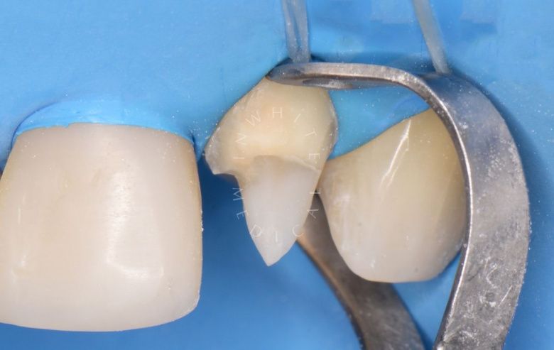 Где лучшая стоматология? Эстетическая реставрация зуба в зоне улыбки - фото до процедуры