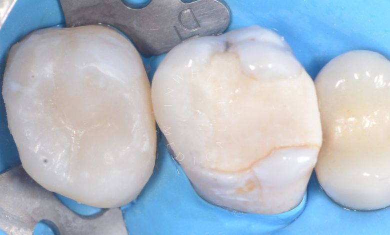 Лучшие стоматологические клиники Москвы. Глубокий кариес жевательного зуба – сохранение зуба - фото после процедуры