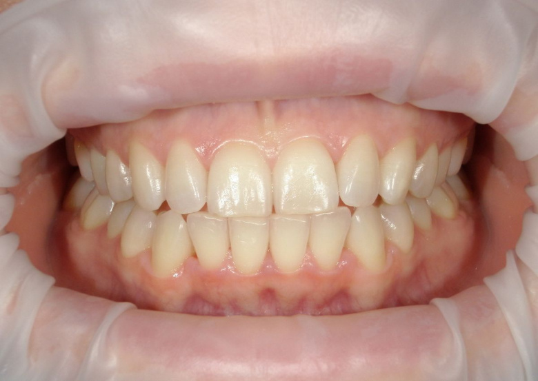 Элитная стоматология. Отбеливание - photo before the procedure