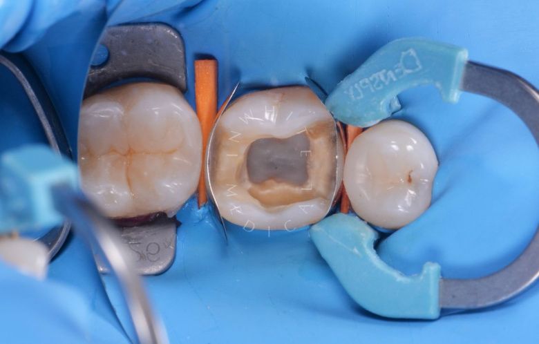 Элитная стоматология. Одиночный кариес жевательного зуба – результат художественной реставрации - фото до процедуры