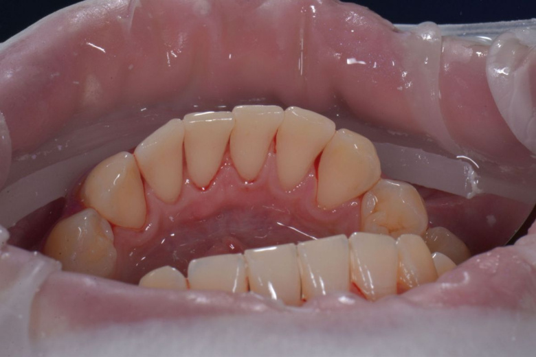 Элитная стоматология. Профессиональная гигиена нижних зубов - photo after the procedure