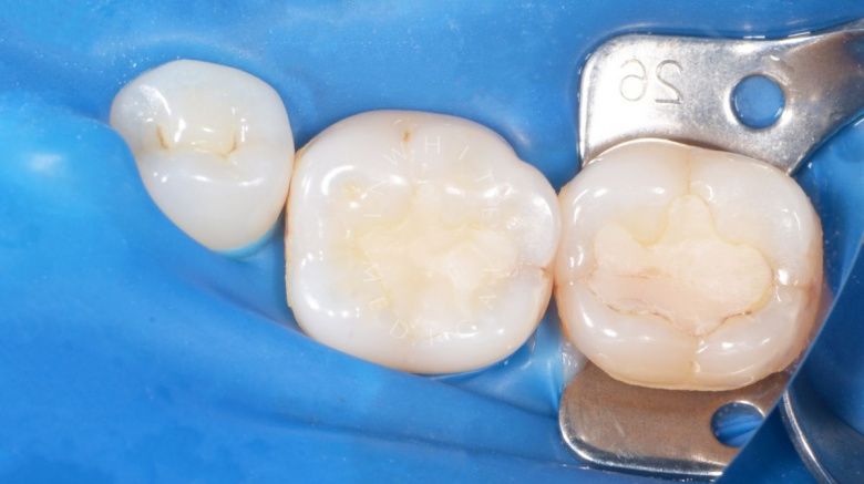 Лучшие стоматологические клиники Москвы. Замена старых реставраций с улучшением эстетики зубов - фото до процедуры