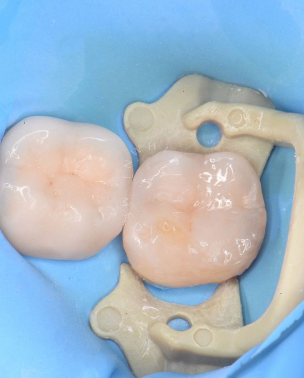 Где лучшая стоматология? Лечение фиссурного кариеса под увеличением - фото после процедуры
