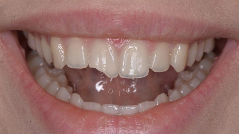 Где лучшая стоматология? Художественная реставрация зуба композитным материалом с восстановлением всех оптических характеристик за один визит. - фото до процедуры