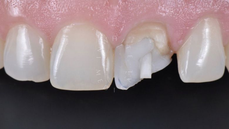 Где лучшая стоматология? Прямая реставрация центрального резца со стекловолоконным штифтом - фото до процедуры