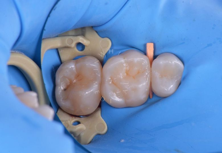 Элитная стоматология. Реставрация зуба с восстановлением естественных фиссур - фото после процедуры