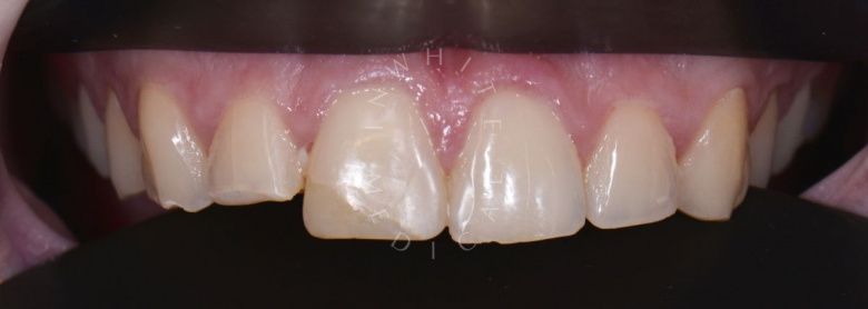 Лучшие зубные клиники Москвы. Художественная реставрация передних зубов - фото до процедуры