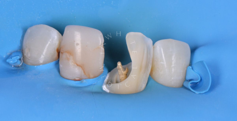 Элитная стоматология. Эстетическая реставрация зуба - photo before the procedure