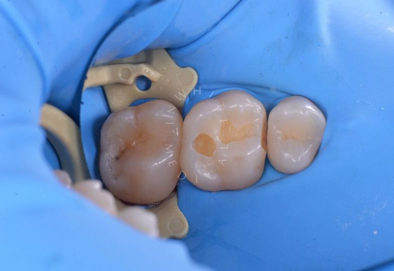 Элитная стоматология. Реставрация зуба с восстановлением естественных фиссур - фото до процедуры